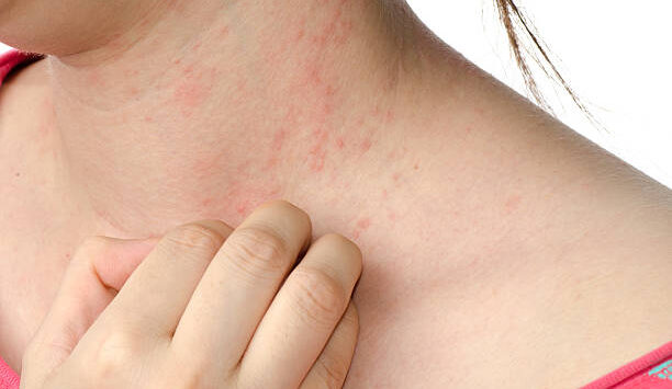 When is an Allergic Reaction Emergency?