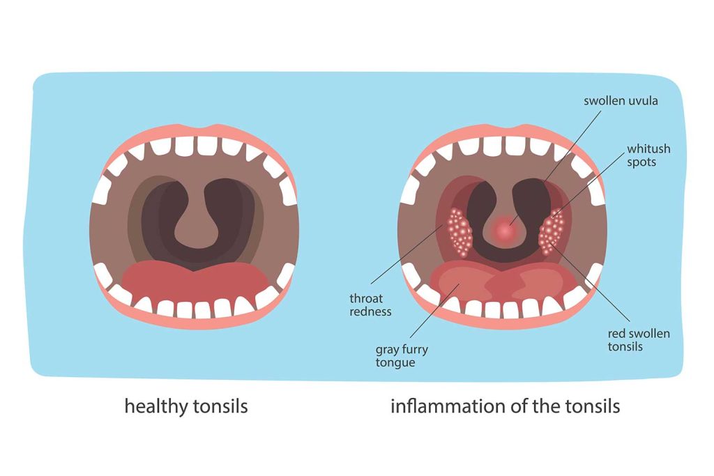Strep Throat - Causes, Symptoms, and When to Seek Emergency Care 1 inflammation of the tonsils symptoms