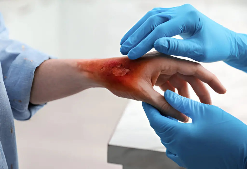 How We Treat Burns at Supreme Care ER